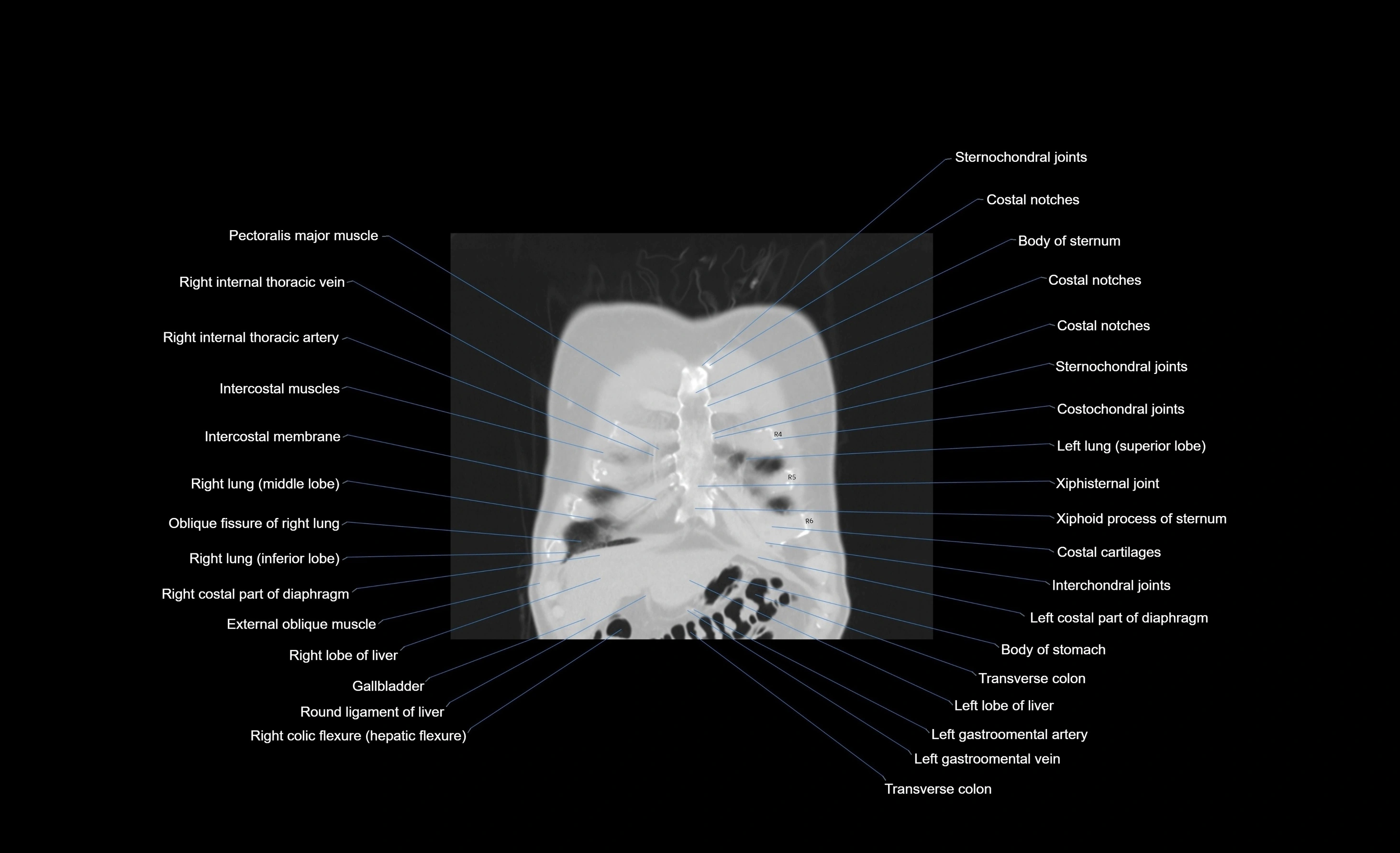 CT chest (thorax) labelled coronal cross sectional anatomy radiology image-00100.webp